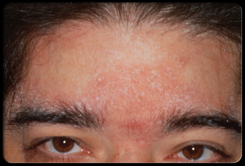 Topical steroids for scalp eczema